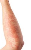 Eczema & Atopic Skin